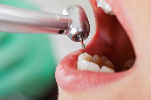 Best Emergency Tooth Extraction in Azusa, CA